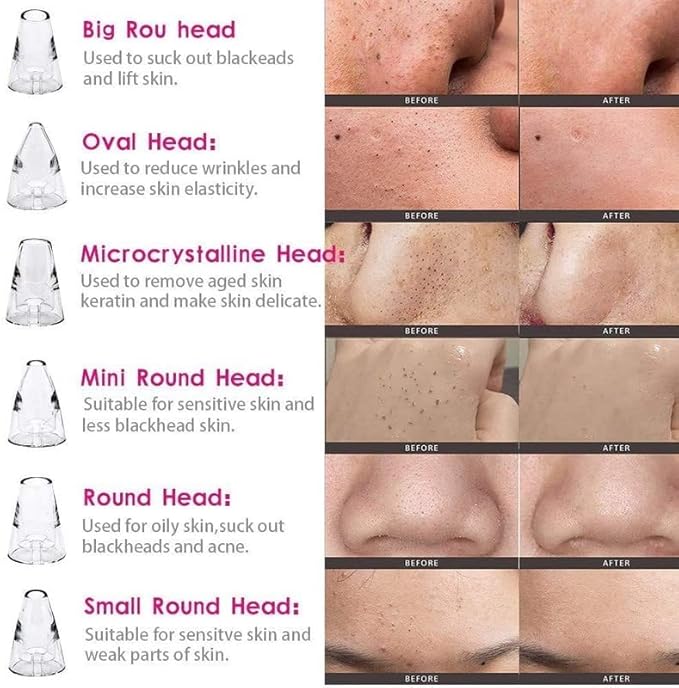 Primepick Blackhead Whitehead Extractor Remover