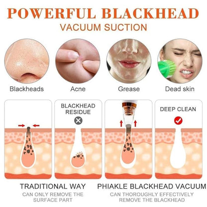 Primepick Blackhead Whitehead Extractor Remover